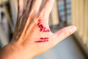 dog bite injury